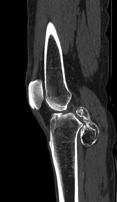 Calcified hematoma - popliteal fossa (Radiopaedia 63938-72763 Sagittal bone window 37).jpg