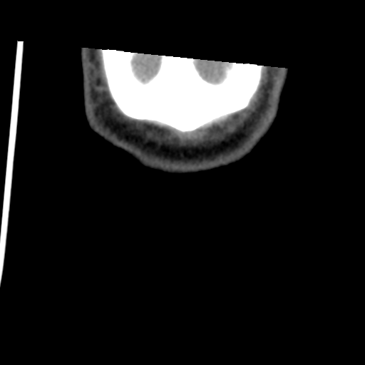 Calcifying pseudoneoplasm of neuraxis (Radiopaedia 44076-47617 Coronal non-contrast 52).png