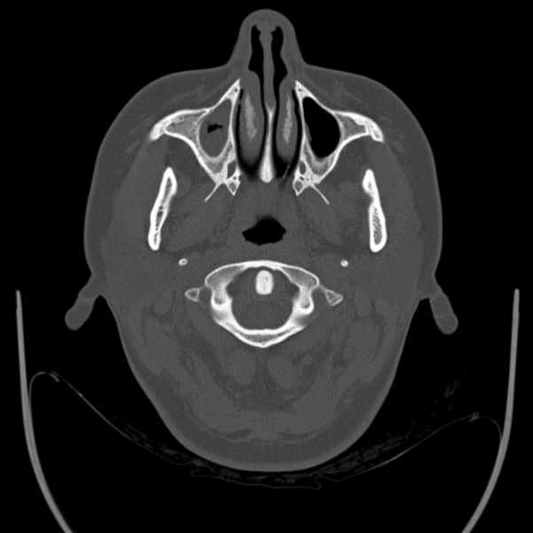 Calvarial osteoma (Radiopaedia 36520-38079 Axial bone window 5).jpg