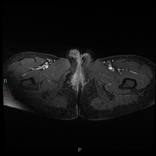 File:Canal of Nuck cyst (Radiopaedia 55074-61448 Axial T1 C+ fat sat 60).jpg