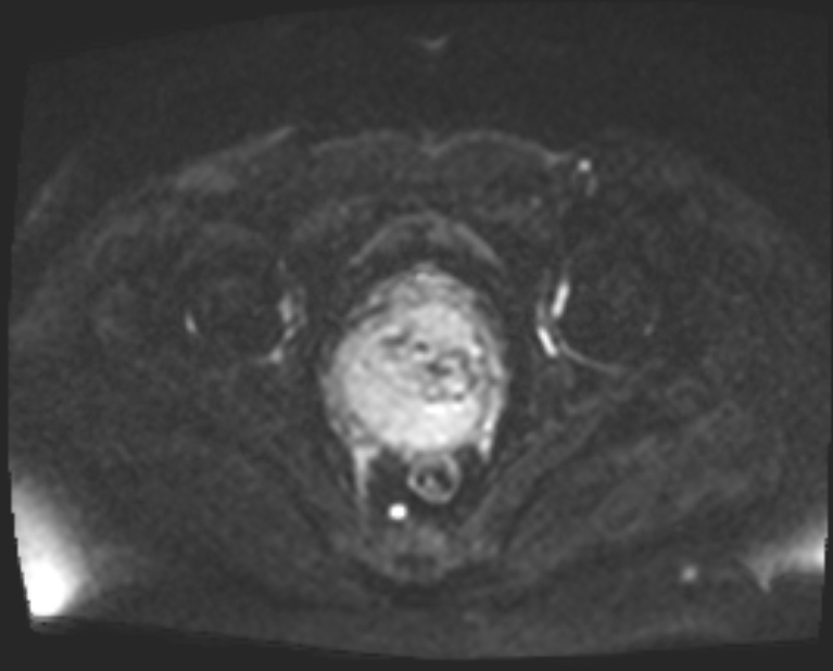 Cancer cervix - stage IIb (Radiopaedia 75411-86615 Axial DWI 39).jpg