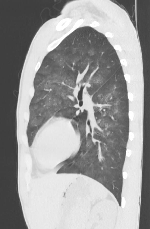 Cannabis-induced diffuse alveolar hemorrhage (Radiopaedia 89834-106946 Sagittal lung window 98).jpg