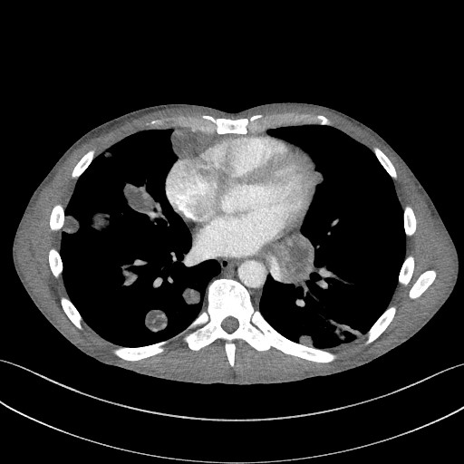 Cannonball metastases - testicular choriocarcinoma (Radiopaedia 84510-99891 B 69).jpg
