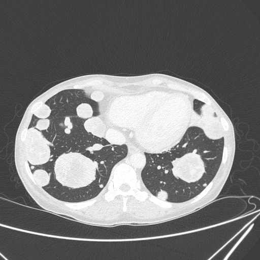 Canonball lung metastasis (Radiopaedia 77634-89837 Axial lung window 136).jpg