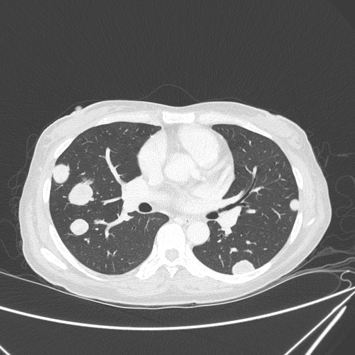 Canonball lung metastasis (Radiopaedia 77634-89837 Axial lung window 89).jpg