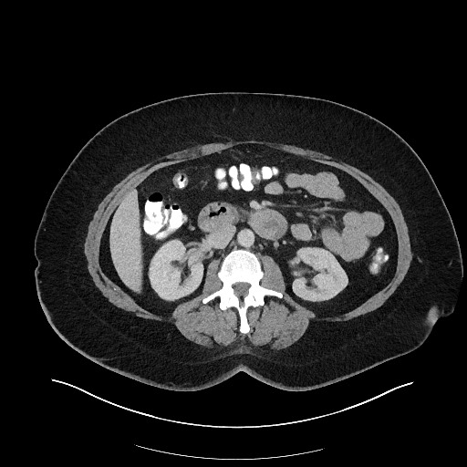 Carcinoid tumor - terminal ileum (Radiopaedia 60931-68739 A 58).jpg