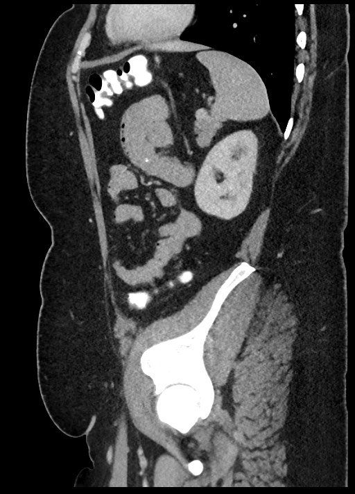 Carcinoid tumor - terminal ileum (Radiopaedia 60931-68739 C 19).jpg