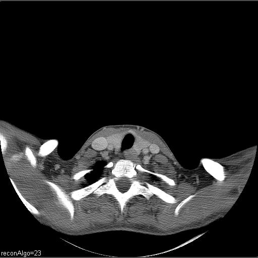 Carcinoma of the maxillary antrum (Radiopaedia 53805-59888 Axial C+ delayed 3).jpg