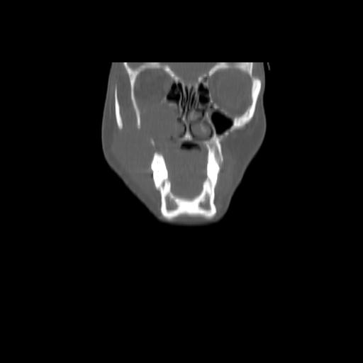 Carcinoma of the maxillary antrum (Radiopaedia 53805-59888 Coronal bone window 32).jpg