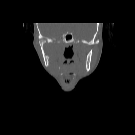 Carcinoma of the maxillary antrum (Radiopaedia 53805-59888 Coronal bone window 74).jpg