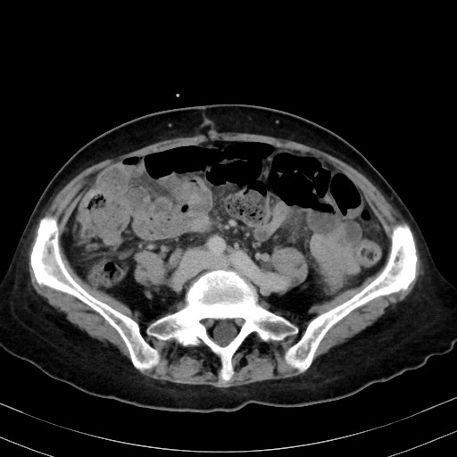 Carcinosarcoma (Radiopaedia 70401-80503 A 42).jpg