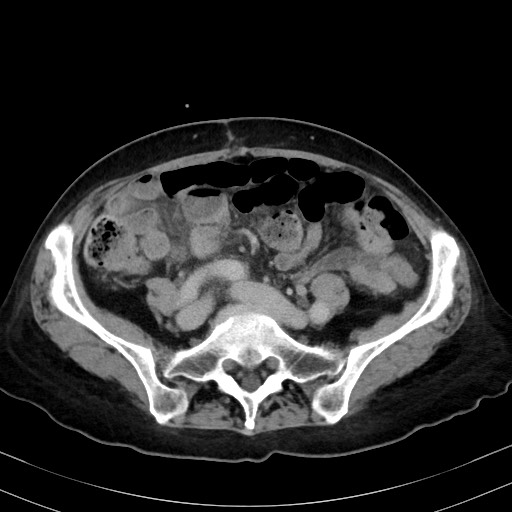 Carcinosarcoma (Radiopaedia 70401-80503 A 44).jpg