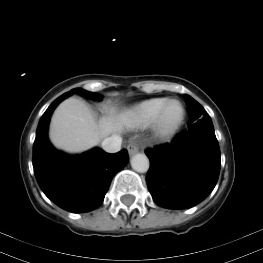 Carcinosarcoma (Radiopaedia 70401-80503 A 6).jpg
