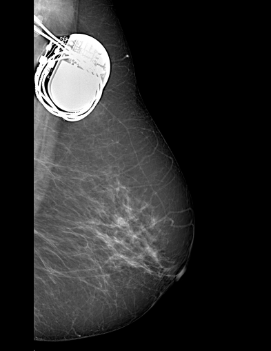 File:Cardiac pacemaker (mammography) (Radiopaedia 72298-82831 L MLO 1).PNG
