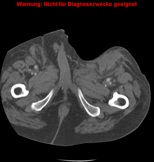 File:Cardiac perforation following transcatheter aortic valve implantation (Radiopaedia 23714-23863 B 20).png