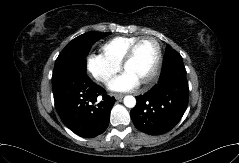 Cardiac sarcoidosis (Radiopaedia 74548-85534 A 59).jpg