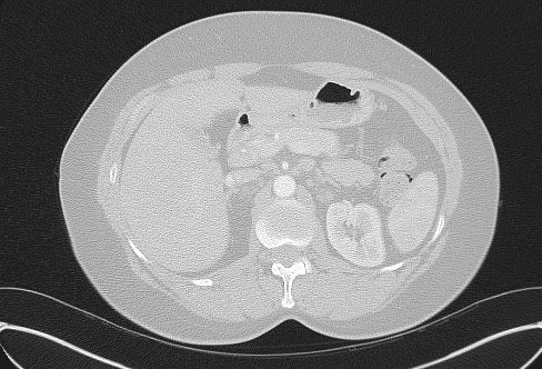 File:Cardiac sarcoidosis (Radiopaedia 74548-85534 Axial lung window 99).jpg