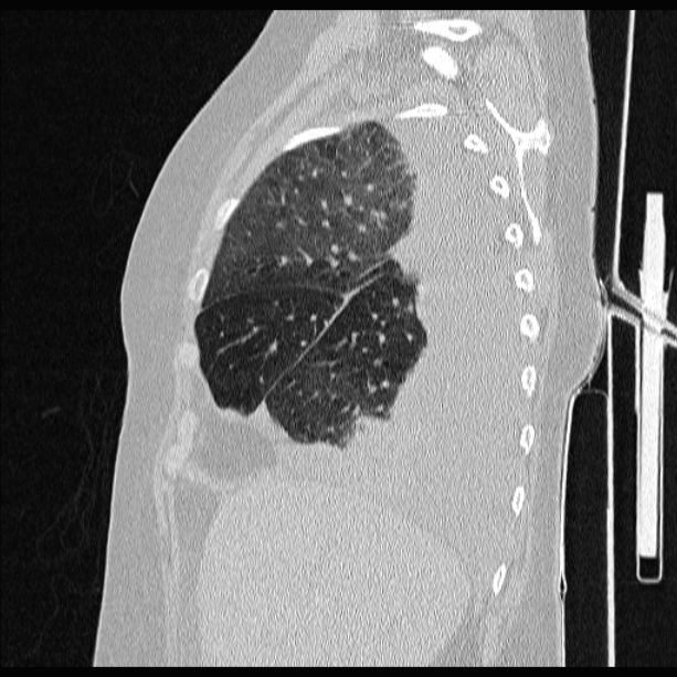 Cardiogenic pulmonary edema (Radiopaedia 29213-29609 Sagittal lung window 24).jpg