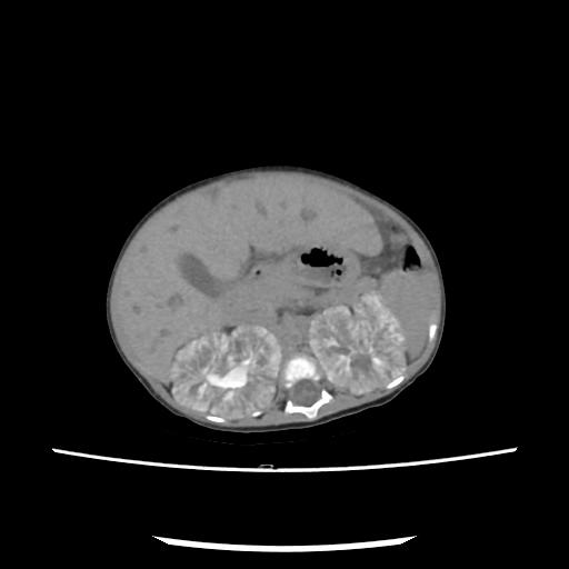 File:Caroli disease with autosomal recessive polycystic kidney disease (ARPKD) (Radiopaedia 89651-106703 E 88).jpg