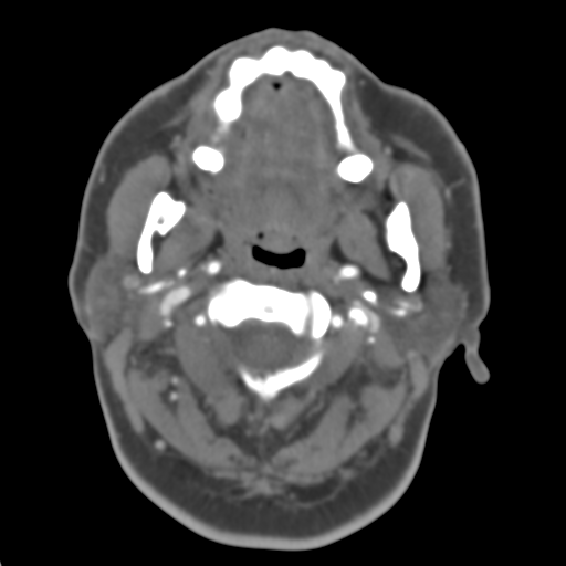 Carotico ophthalmic aneurysm (Radiopaedia 42916-46148 A 54).png