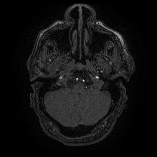 Carotid arterial dissection with acute cerebral infarction (Radiopaedia 26636-26784 MRA 148).jpg