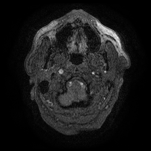 Carotid arterial dissection with acute cerebral infarction (Radiopaedia 26636-26784 MRA 170).jpg