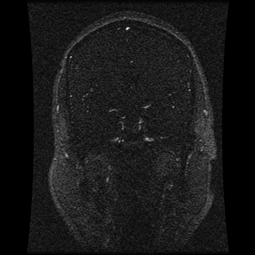 Carotid arterial dissection with acute cerebral infarction (Radiopaedia 26636-26784 MRV 104).jpg
