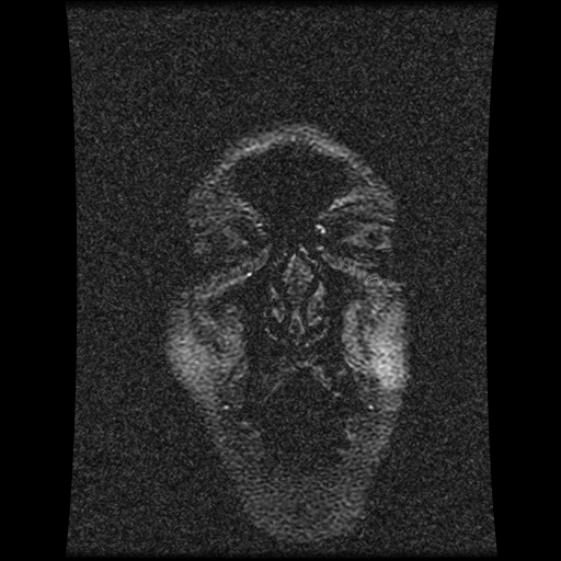 Carotid arterial dissection with acute cerebral infarction (Radiopaedia 26636-26784 MRV 150).jpg
