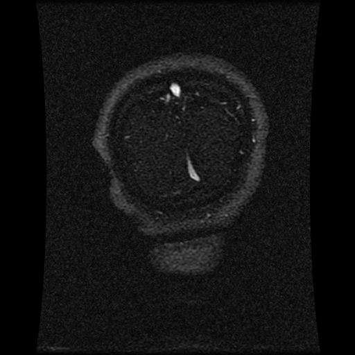 Carotid arterial dissection with acute cerebral infarction (Radiopaedia 26636-26784 MRV 37).jpg