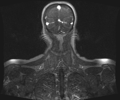 Carotid body tumor (Radiopaedia 12777-12912 MRA 70).jpg