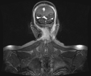 Carotid body tumor (Radiopaedia 12777-12912 MRA 77).jpg