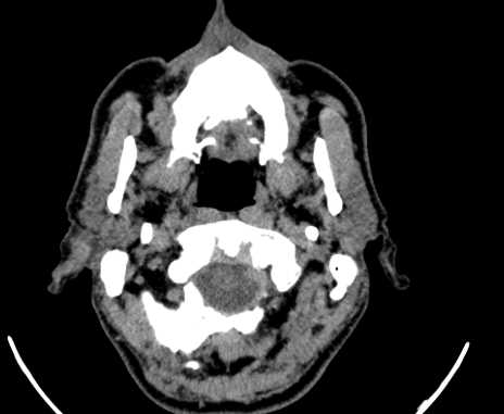 Carotid body tumor (Radiopaedia 61750-69757 Axial non-contrast 7).jpg