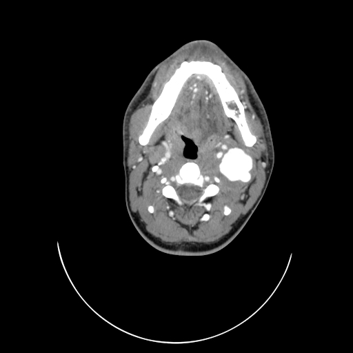 File:Carotid bulb pseudoaneurysm (Radiopaedia 57670-64616 A 24).jpg