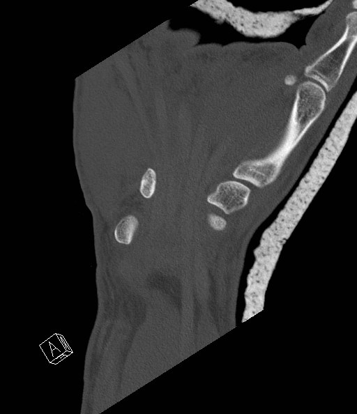 File:Carpal fractures (smart watch impaction) (Radiopaedia 55844-62430 Coronal bone window 20).jpg