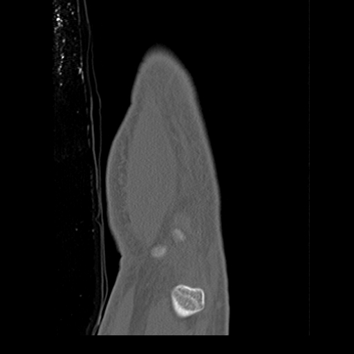 File:Carpo-metacarpal fracture-dislocations with hamatum split fracture (Radiopaedia 18482-18343 Sagittal bone window 3).jpg