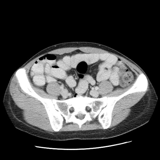 File:Castleman disease with fibrous pseudotumor in the abdomen (Radiopaedia 77296-89373 A 91).jpg