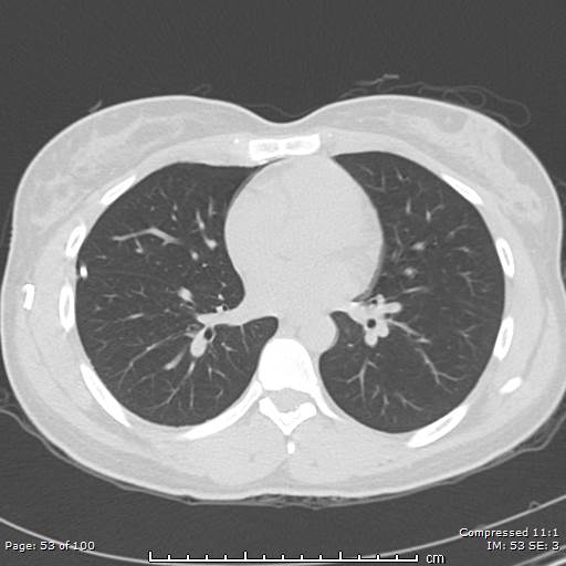 Catamenial pneumothorax (Radiopaedia 54382-60600 Axial non-contrast 53).jpg