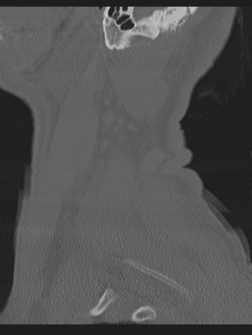 Cavernoma of cervical cord (Radiopaedia 50838-56346 Sagittal bone window 75).png