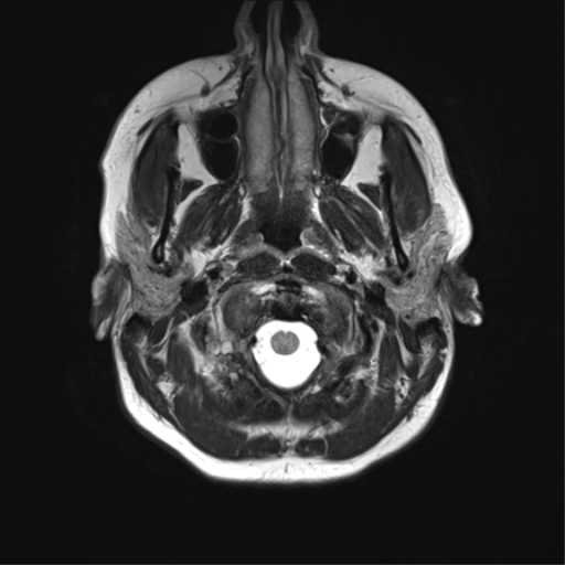 File:Cavernoma with bleed - midbrain (Radiopaedia 54546-60773 Axial T2 2).png