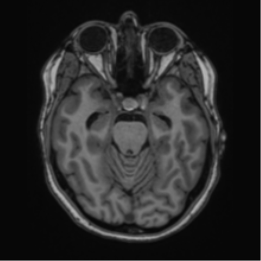 Cavernoma with bleed - midbrain (Radiopaedia 54546-60774 Axial T1 10).png