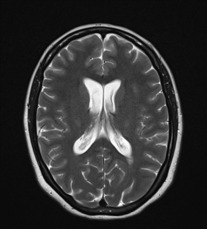 File:Cavernoma with bleed - midbrain (Radiopaedia 54546-60774 Axial T2 16).png