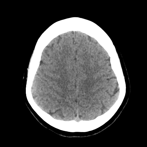 Cavernoma with hemorrhage (Radiopaedia 70755-80931 Axial non-contrast 40).png