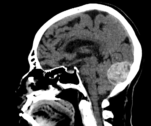 Cavernous hemangioma of the cerebellar falx (Radiopaedia 73025-83723 B 159).jpg