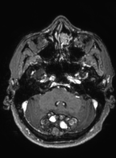 File:Cavernous hemangioma of the cerebellar falx (Radiopaedia 73025-83724 Axial T1 C+ 256).jpg