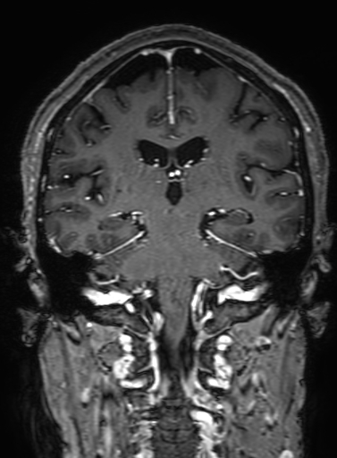 Cavernous hemangioma of the cerebellar falx (Radiopaedia 73025-83724 Coronal T1 C+ 219).jpg