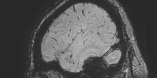 Cavernous hemangioma of the cerebellar falx (Radiopaedia 73025-83724 Sagittal BOLD 176).jpg