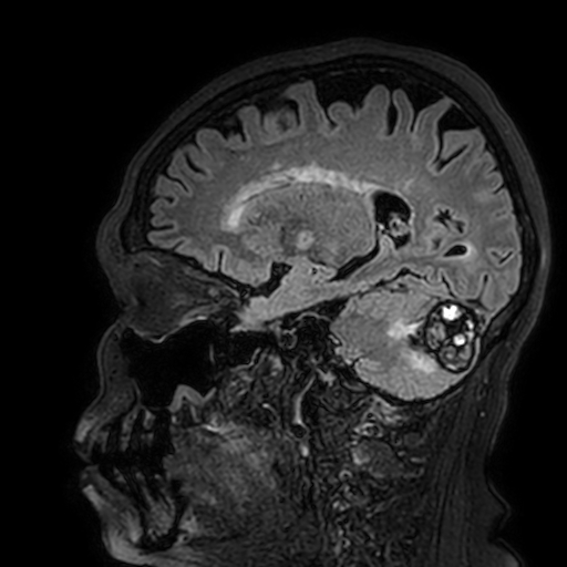 Cavernous hemangioma of the cerebellar falx (Radiopaedia 73025-83724 Sagittal FLAIR 142).jpg