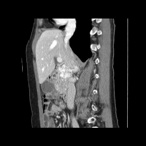 Cavernous hepatic hemangioma (Radiopaedia 75441-86667 D 80).jpg