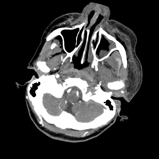 File:Cavernous sinus thrombosis (Radiopaedia 10619-11078 A 8).jpg