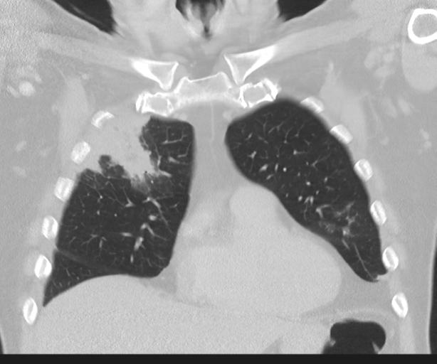 Cavitating pneumonia (Radiopaedia 45998-50329 Coronal lung window 15).png